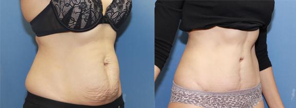full tummy tuck after two pregnancies.
