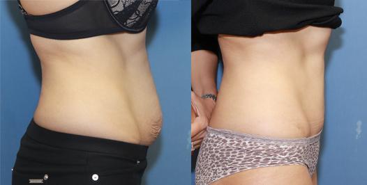 full tummy tuck after two pregnancies.