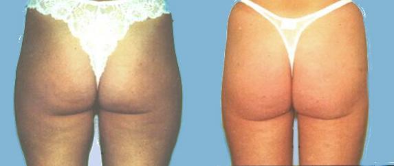 Liposuction of thighs and saddlebags to shape the buttocks and slim the thighs