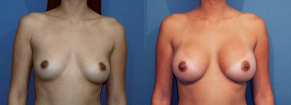 full C cup size breast augmentation with breast implants.