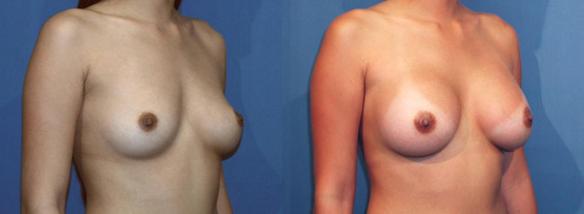 full C cup size breast augmentation with breast implants.