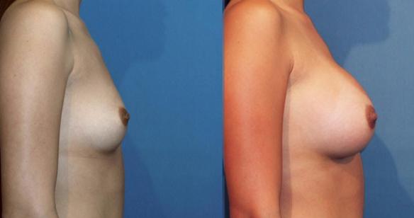 full C cup size breast augmentation with breast implants in Beverly Hills 90210