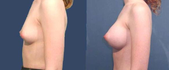 breast augmentation, breast enhancement, breast implants C cup size