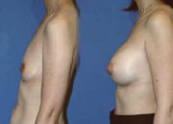 breast enhancement with breast implants C cup size