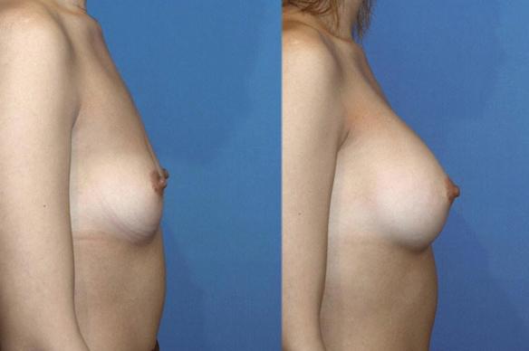 breast enlargement with breast implants C cup size