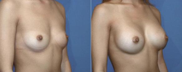 breast enlargement to a C cup size with silicone breast implants