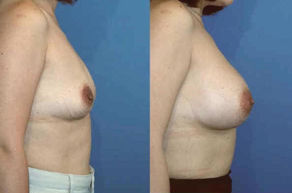 breast enlargement full C cup size with silicone breast implants.