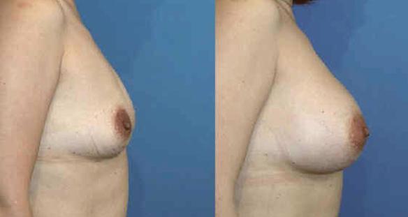breast enlargement to a full C cup size  breast implants