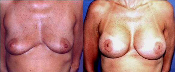 breast uplift with breast implants