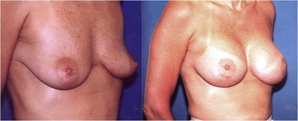 breast lift with breat implants