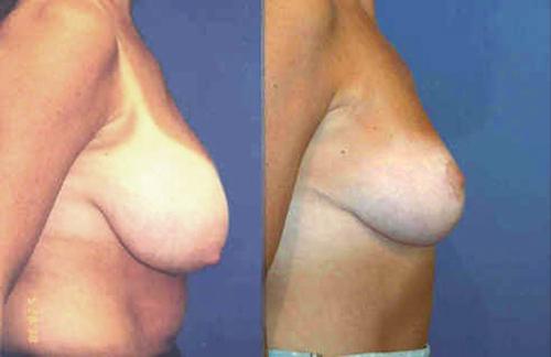 breast reduction from DD cup to a D cup size