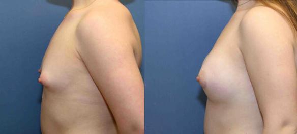 A cup size breast to a B cup size with silicone breast implants