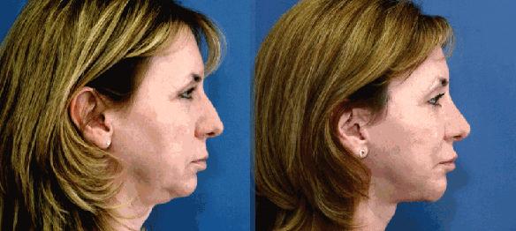 rhinoplasty, chin implant and facelift plastic surgery