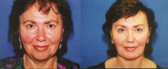 brow lift with face lift and neck lift