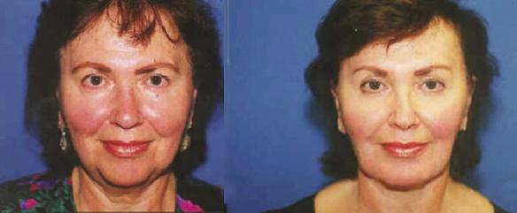 face lift brow lift, chin implant 