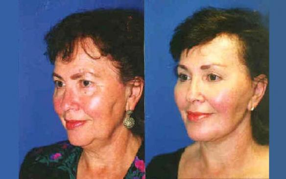 face lift, brow lift, chin implant