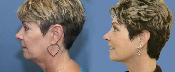 face lift, neck lift and face peel laser to restore youthful appearance.