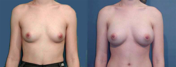 breast augmentation, breast enlargement, breast implants C cup size