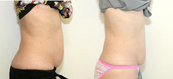iLipo body sculpting and laser fat reduction