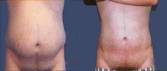 liposuction stomach male body sculpting