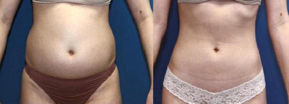 liposuction stomach or tummy 