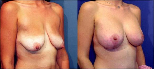 breast lift or mastopexy with silicone breast implants.