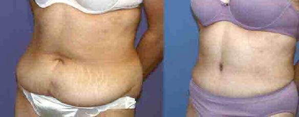 tummy tuck or abdominoplasty for body sculpting Beverly HIlls, Woodland Hills