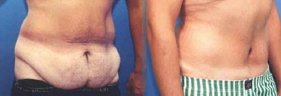 Male tummy tuck or male abdominoplasty